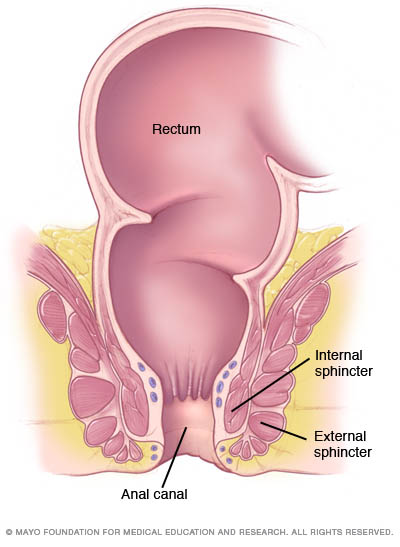 internal anal fissure