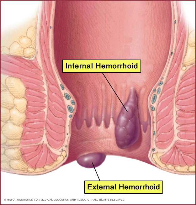 hemorrhoid diagram | Mayo Foundation